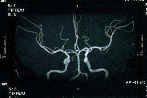 頭部MRI・MRA検査